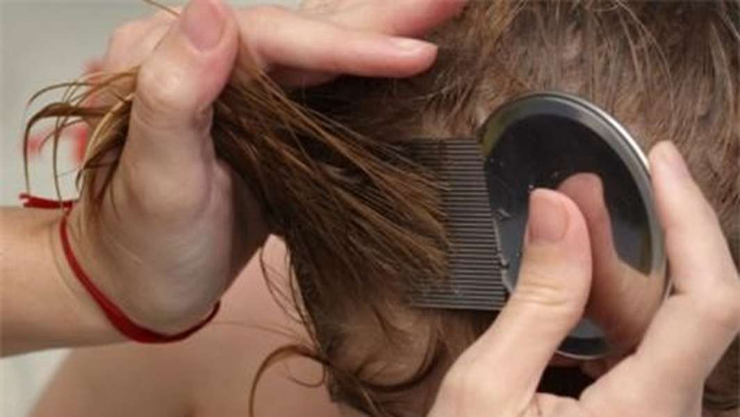 Chấy (Chí) - Hình ảnh minh họa